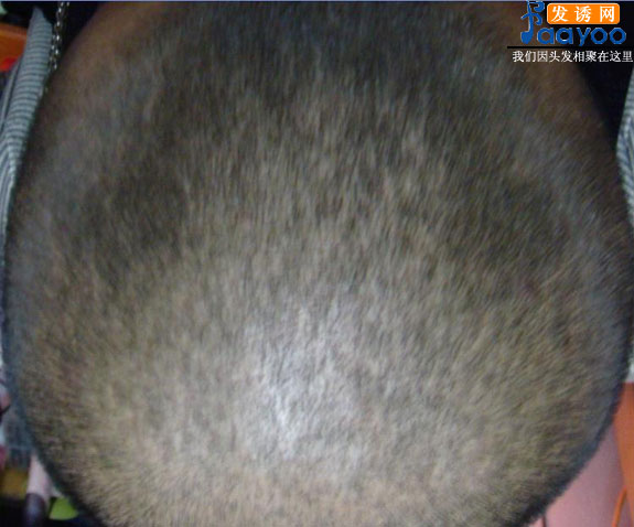 头顶<em>头发</em>稀少,可以做<em>局部</em>的假发么,会不会太假