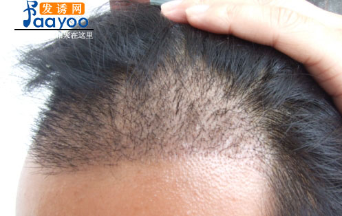 这张是我做完手术大概20天,毛茬还没有掉的样子