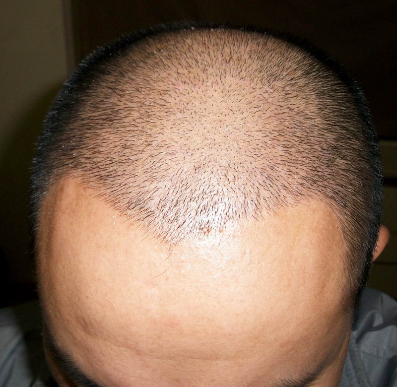 10月22日南京植发fueptt3023单位五级脱发极度严重后脑