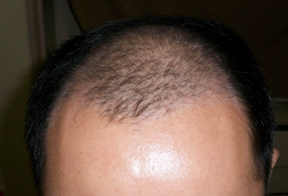 10月22日南京植发fueptt3023单位五级脱发极度严重后脑