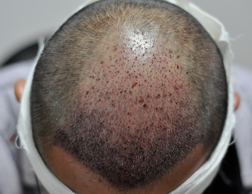 记录我的植发之路