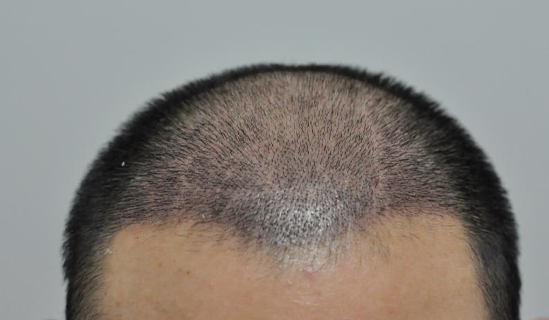 记录我的植发之路